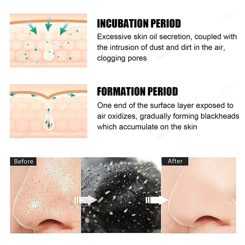 Diagram showing the formation of blackheads with labeled stages and text.